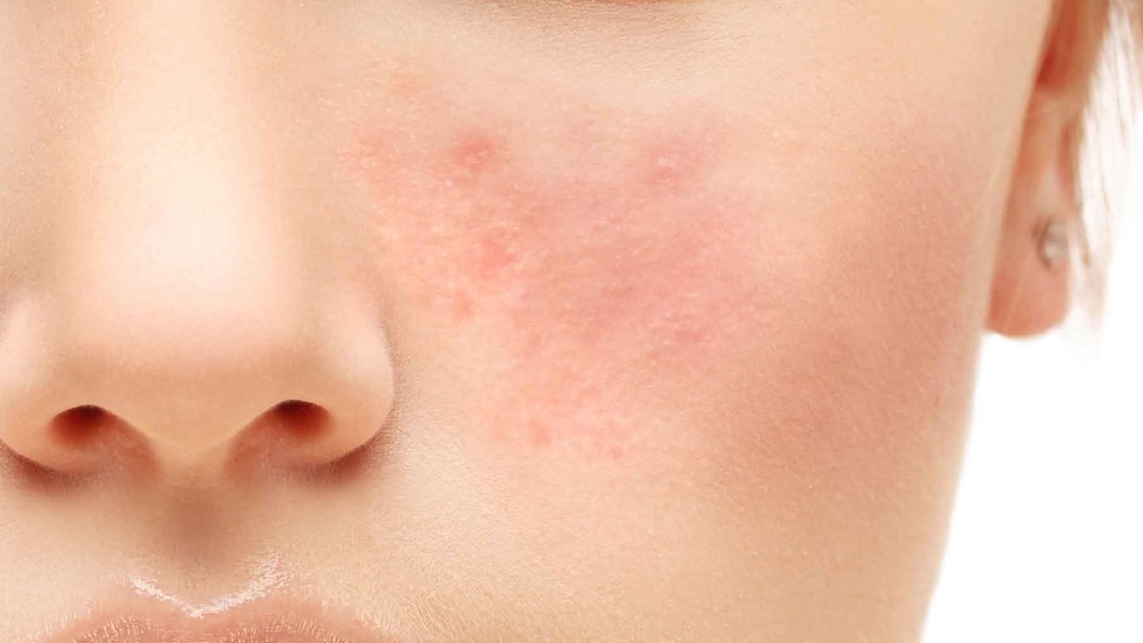 rosacea